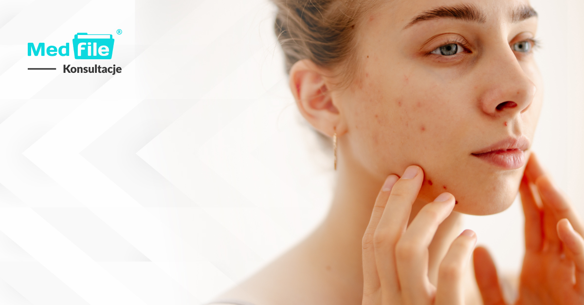 Recepta na Epiduo: wsparcie skóry przy nasilonym trądziku z zapaleniem