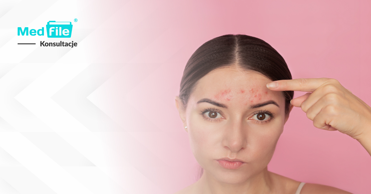 Recepta online na Aklief. Leczenie trądziku pospolitego skóry twarzy i tułowia