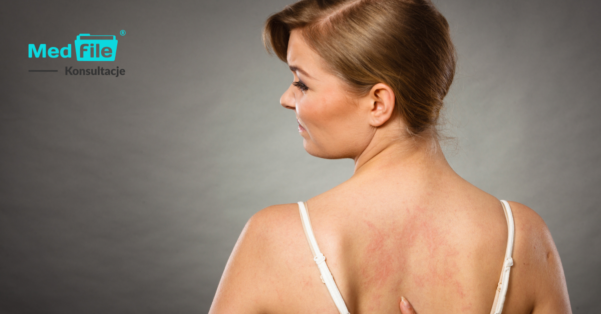 E-recepta na Elidel: skuteczne łagodzenie objawów egzemy skóry